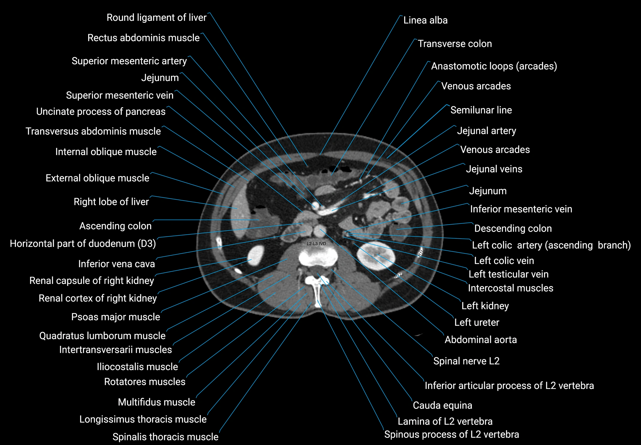 CT male pelvis axial cross sectional anatomy labelled radiology image -00080.webp